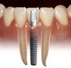 Fake Teeth Implants