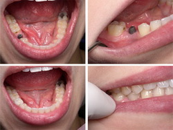 Front Teeth Implants