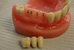 Implants Teeth Pictures