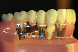 Partial Teeth Implants